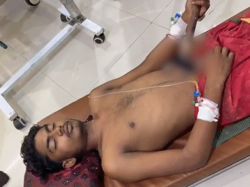 छात्र के पेट से आर-पार हुई 7 फीट की लाठी:गिल्ली-डंडा खेलते समय बाउंड्री से गिरा, कानपुर में डॉक्टरों ने ग्राइंडर से काटकर निकाला