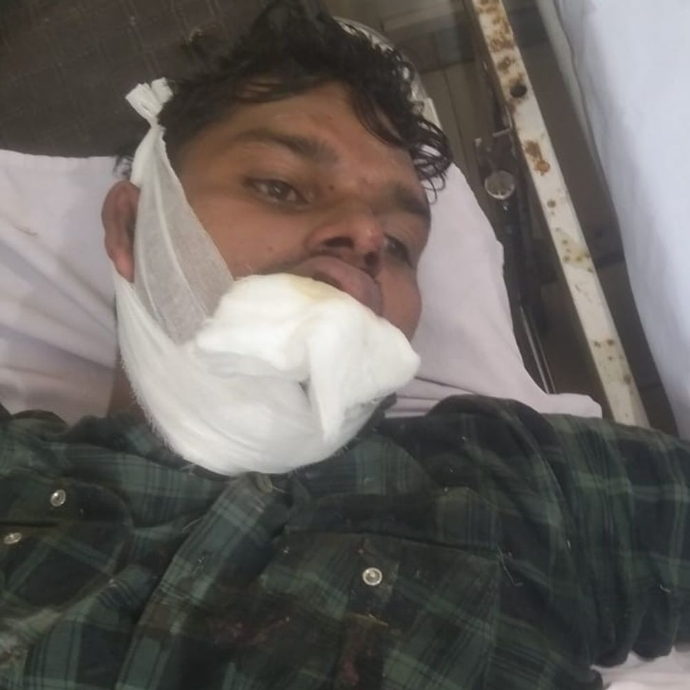 हाईटेंशन लाइन की चपेट में आकर तीन लाइनमैन झुलसे:करंट लगने से दोनों हाथ झुलसे, जबड़ा टूटा, स्ट्रीट लाइट सही करने गए थे