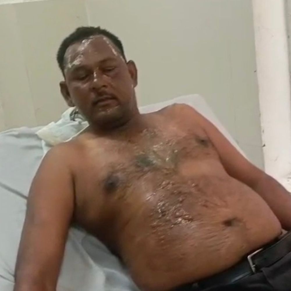 चाय के ठेले पर विवाद, युवक पर फेंकी खौलती केतली:गंभीर रूप से झुलसा, मेडिकल कॉलेज में भर्ती; पुलिस जांच में जुटी