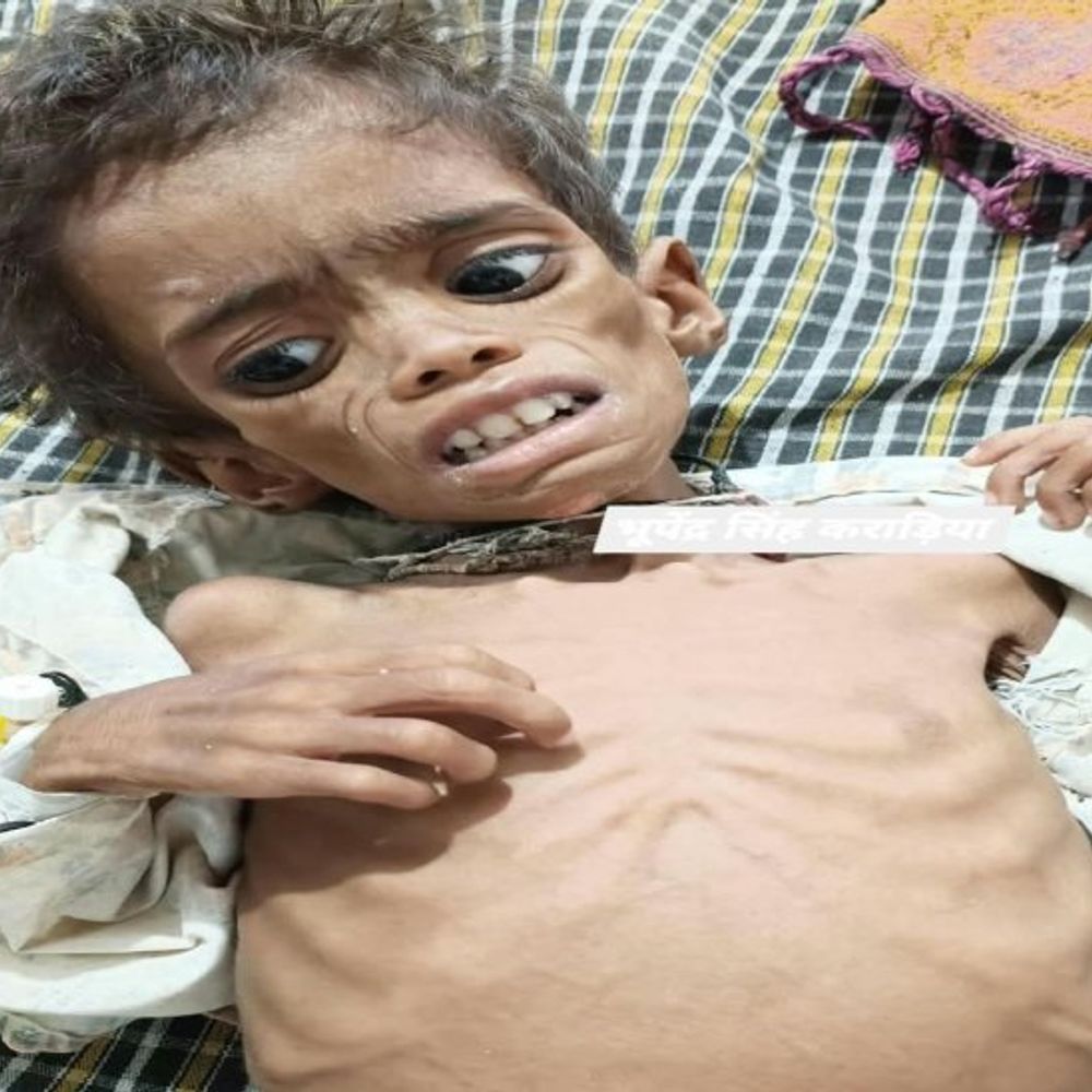 कागजों में कुपोषण मुक्त श्योपुर:50 फीसदी मासूम बिना स्वस्थ हुए सिस्टम से बाहर, पंजीयन का लक्ष्य 166 फीसदी पार