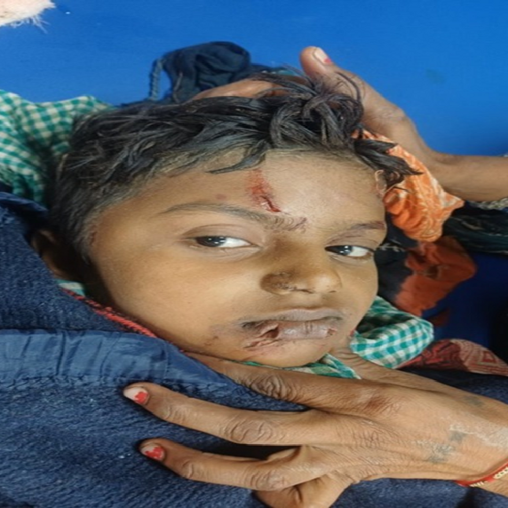 अंबाला में आवारा कुत्तों का आतंक:9 साल के बच्चे को घेरकर बुरी तरह नोचा, चेहरे-होंठ समेत शरीर पर 30 से ज्यादा घाव