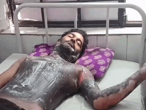 युवक ने खुद पर पेट्रोल डालकर आग लगाई:पत्नी बोली- घरेलू विवाद से तनाव में आकर पति ने यह कदम उठाया