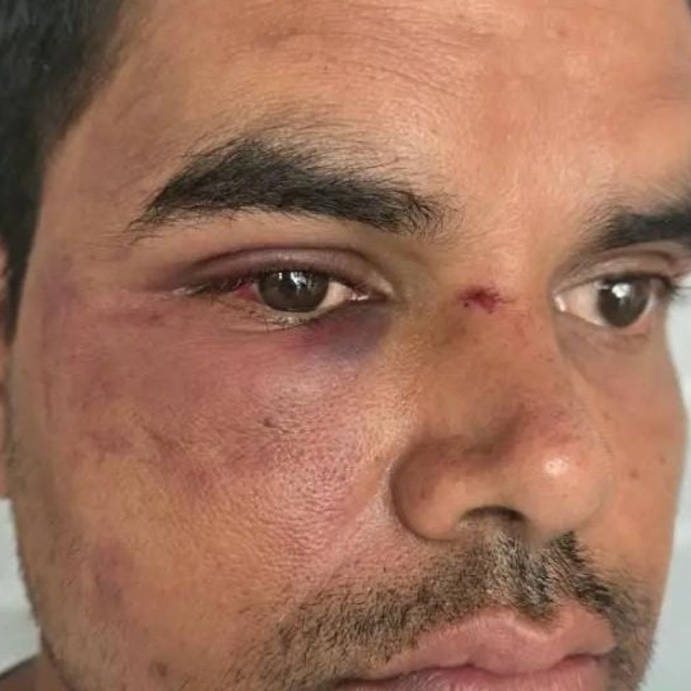 कोरबा में रेलवे सुपरवाइजर की पिटाई, हालत गंभीर:भर्ती और पुरानी रंजिश को लेकर मारपीट; 5 आरोपी गिरफ्तार, जेल भेजे