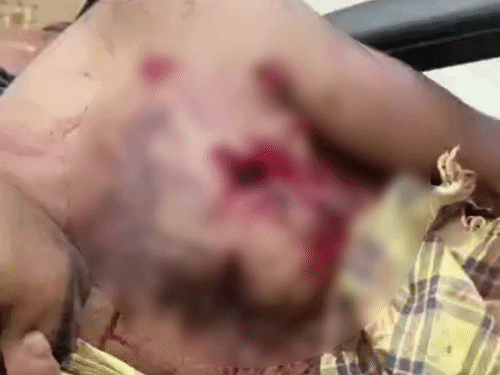 सुकमा में भालू ने दो ग्रामीणों पर हमला किया:बाघ की दहशत के बीच जंगल में मवेशी चराने गए थे, बेहतर इलाज के लिए रेफर