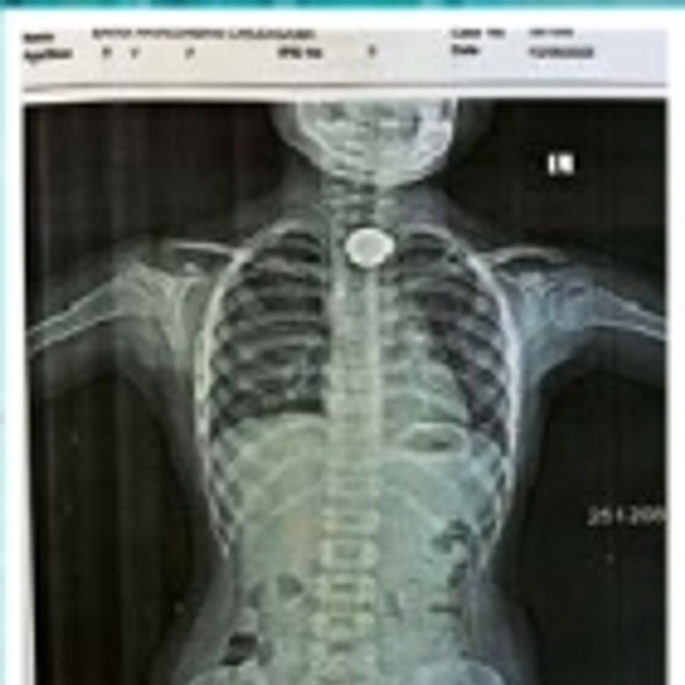 સાત વર્ષની બાળકીએ સિક્કો ગળતા ટીંબી હોસ્પિટલમાં સફળ સર્જરી