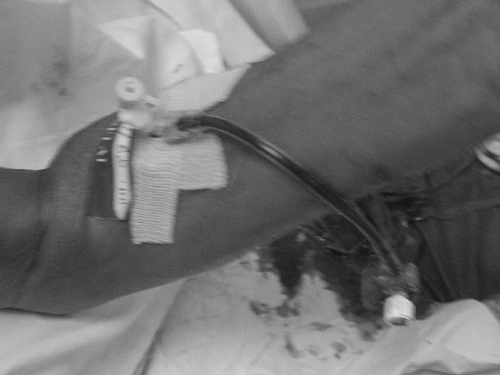 SVP હોસ્પિટલમાં ICUમાં દર્દીના હાથની નળી નીકળી જતાં લોહી વહી ગયું