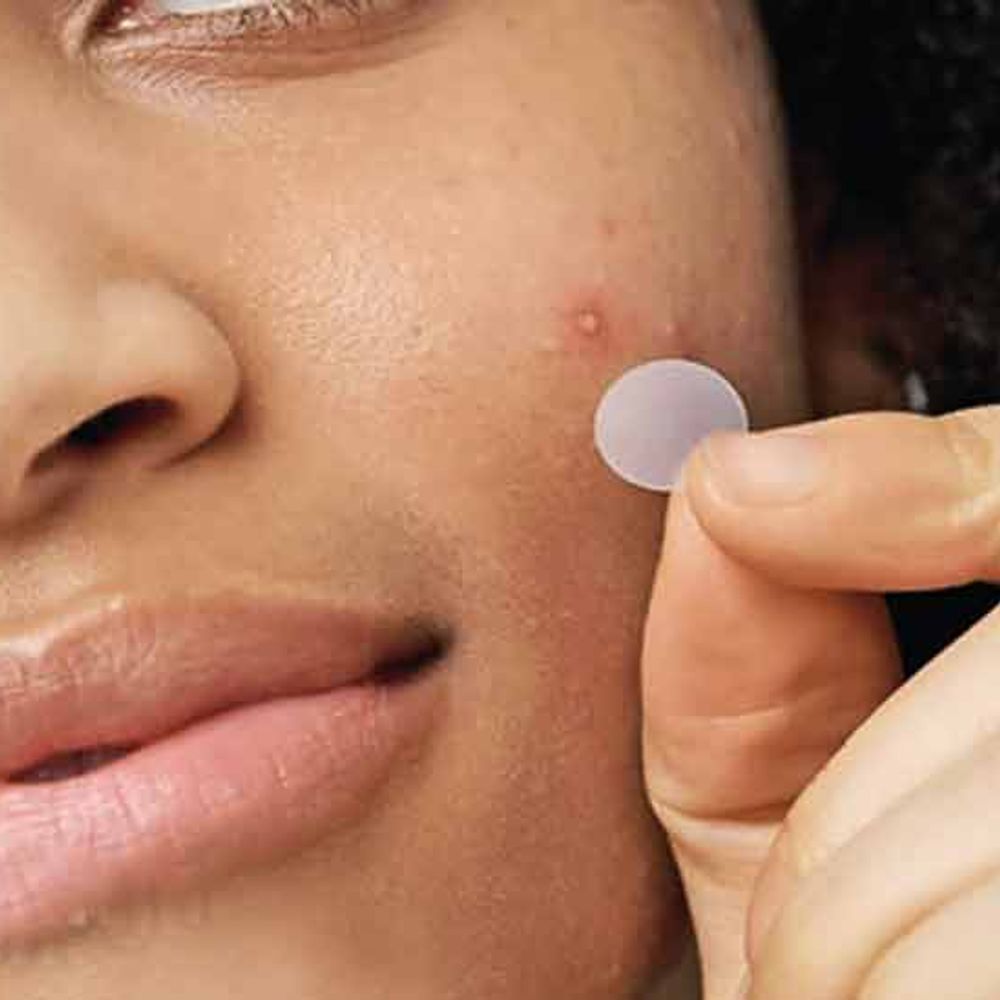 બ્યૂટી:પિમ્પલ પેચ: નાનું સ્ટિકર, મોટું કામ!