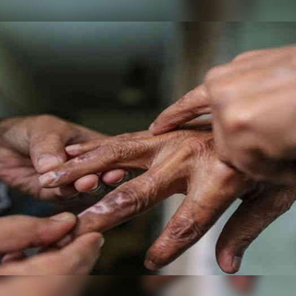 5 વર્ષમાં 1287 દર્દીઓ રક્તપિત્ત મુક્ત થયા