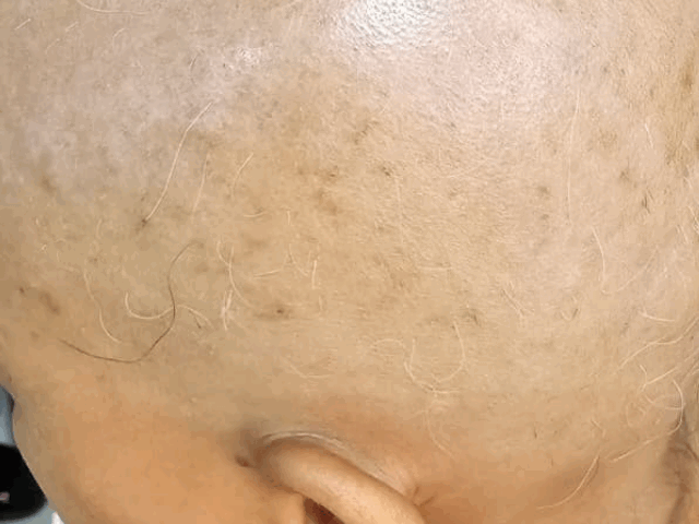 ટાલિયાપણું હવે અસાધ્ય નથી! 34 વર્ષીય મહિલાને કુદરતી રીતે વાળ ઉગ્યા: ગાંધીનગરની આયુર્વેદ હોસ્પિટલમાં સફળ સારવાર.