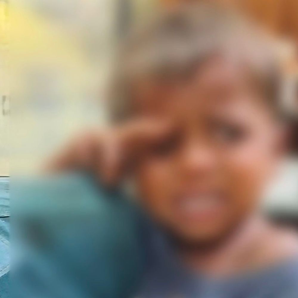 કાલોલના બાળકના નાકમાં મકાઈનો દાણો ફસાયો:ગોધરા સિવિલમાં સફળતાપૂર્વક બહાર કઢાયો, બાળકે રાહત અનુભવી