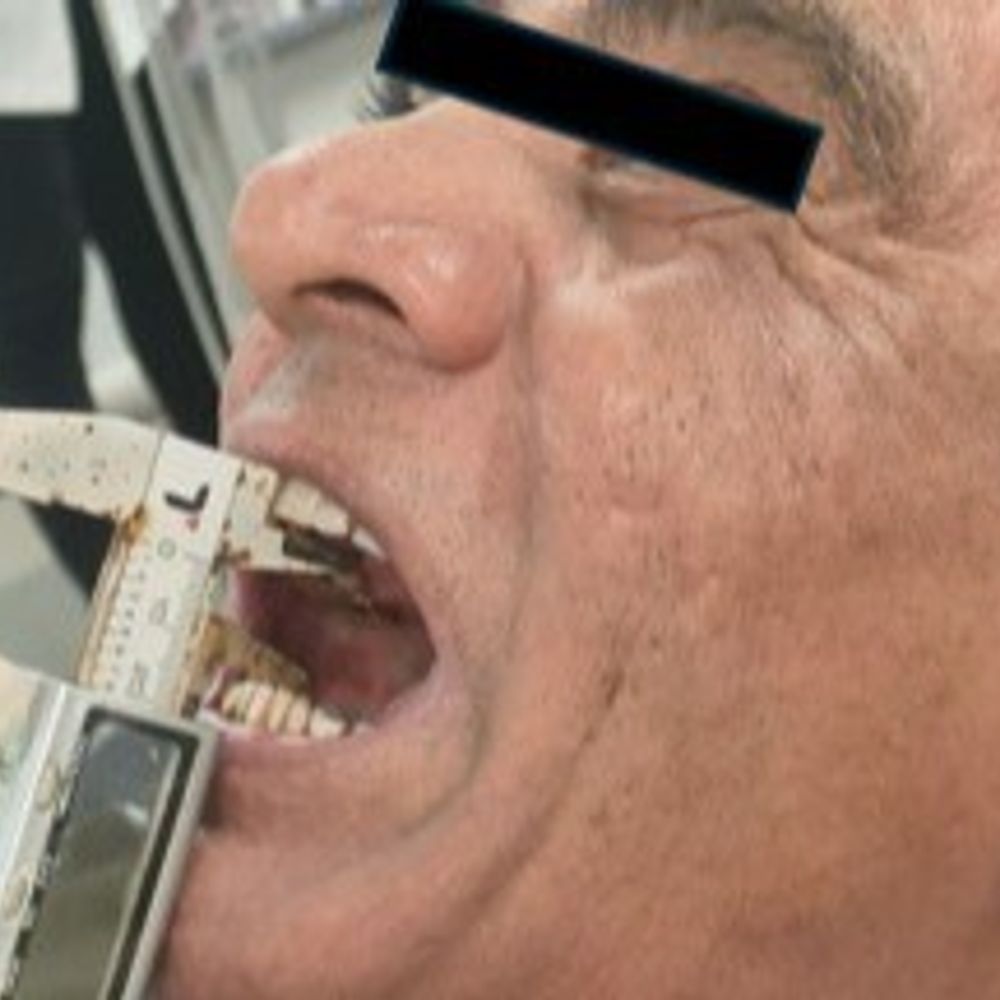 ઓરલ કેન્સર સામે અમદાવાદની GDCHની ઢાલ:33 જિલ્લામાં 282 ડેન્ટિસ્ટનું મહાઅભિયાન અને 2.24 લાખથી વધુ દર્દીઓને મળી નિઃશુલ્ક સારવાર