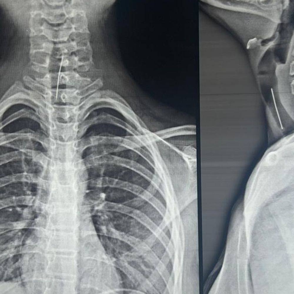 વાલીઓ માટે લાલબત્તી સમાન કિસ્સો:ભરૂચની 13 વર્ષીય બાળકીની શ્વાસનળીમાંથી 4 સેમીની પિન સર્જરી કરી બહાર કાઢી