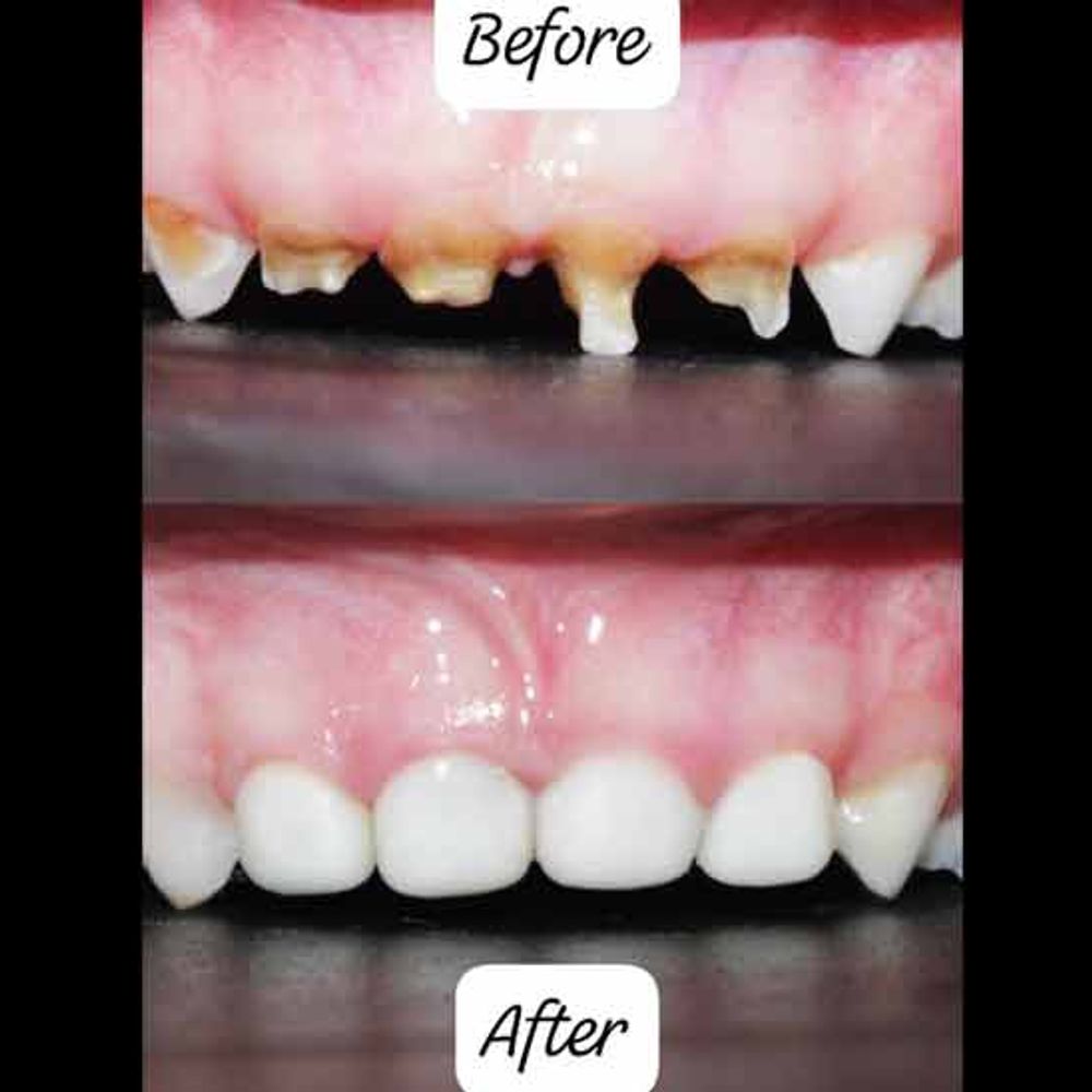 બાળકનું નિર્દોષ સ્મિત: ECCથી પ્રભાવિત બાળકો અને જાગૃતિ.