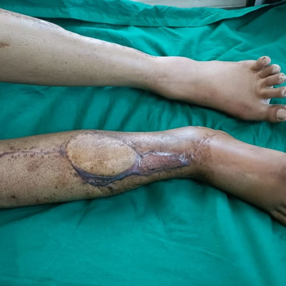 સુરત સિવિલમાં દુર્લભ હાડકાના ટ્યુમરની સફળ સર્જરી:દર્દીની 5 ક્લાક સર્જરી બાદ તક્લીફ દૂર, ઉધનાના આધેડને નવી જીંદગી મળી