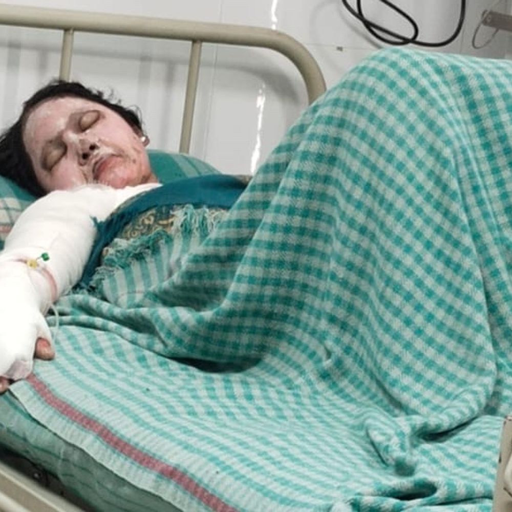 ગેરકાયદેસર ગેસ રિફિલિંગના કારણે બ્લાસ્ટ થતાં 3 ઈજાગ્રસ્ત:ડિંડોલીમાં ગેસ લીકેજ બાદ લાઈટની સ્વીચ પાડતા જ પ્રચંડ વિસ્ફોટ સર્જાયો, બે માસૂમ બાળકો અને માતા ગંભીર રીતે દાઝ્યા