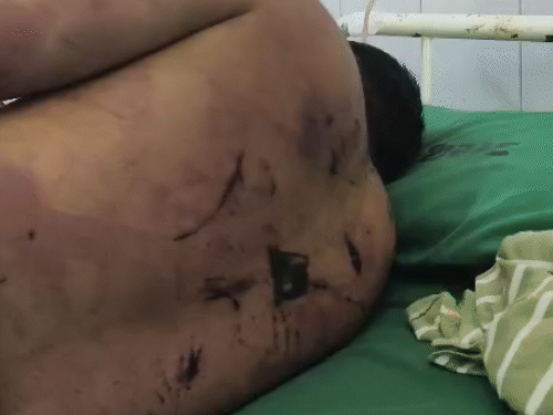 ગુપ્ત ભાગે ટ્યુબ, ઈન્જેક્શન, કપડાં પહેરાવી ડાન્સ, ટોયલેટનું પાણી; મૈત્રી કરારમાં યુવતીના પરિવારે યુવક સાથે અમાનવીય વર્તન.