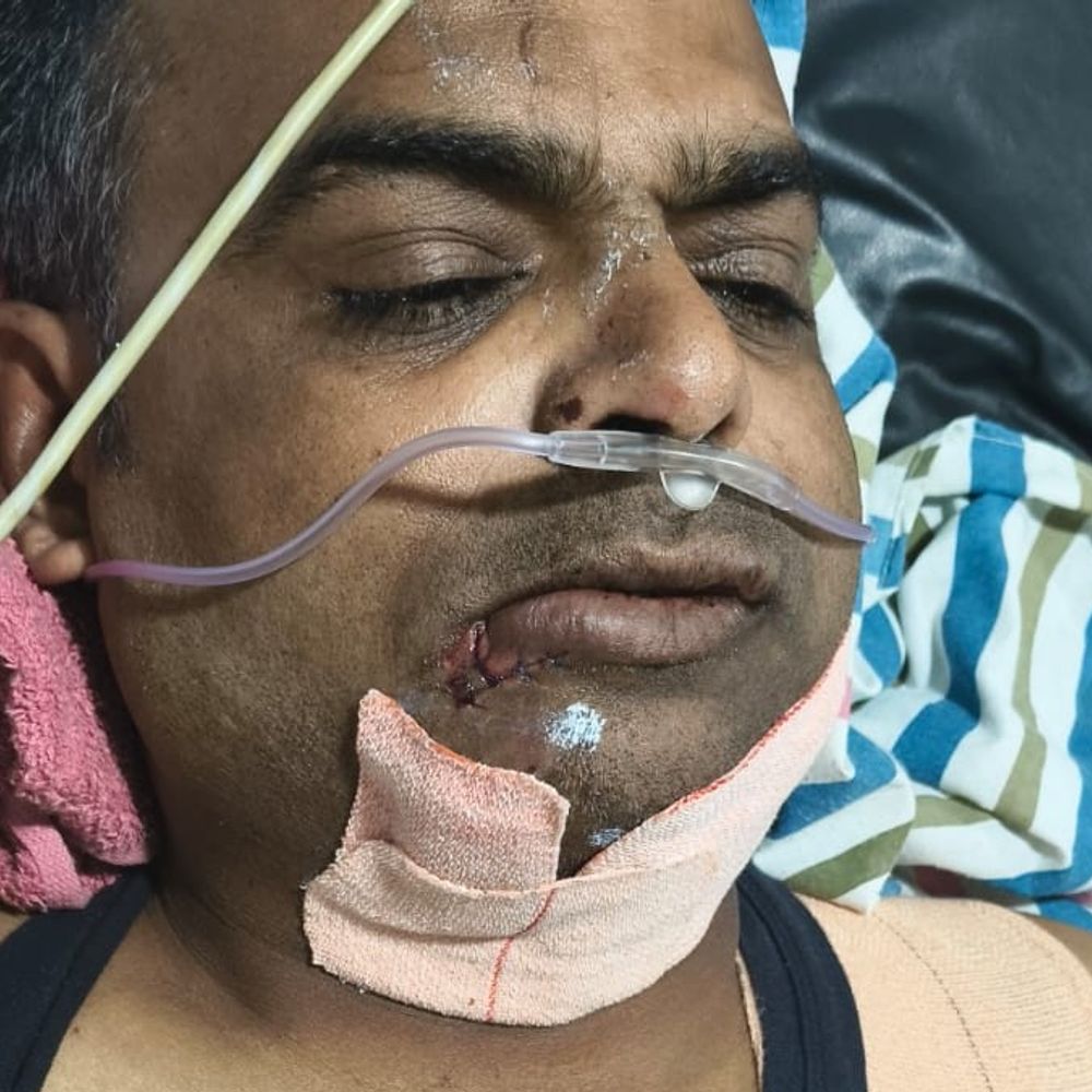 પાટણ રેલવે અંડરબ્રીજની કામગીરીમાં બેદરકારીનો કોન્ટ્રાક્ટર સામે ગુનો:ખાલકશાપીર ફાટક પાસે સુરક્ષાના અભાવે ખાડામાં પડતા ઊંઝા STના મિકેનિકને ગંભીર ઈજા થઈ હતી