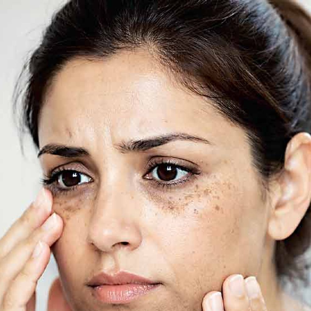 પાંચમો વેદ:આંખ પાસે બ્રાઉન સ્પોટ્સ અને મોંની આસપાસ કાળાશ આવી ગઈ છે, ઉપાયમાં મારે શું કરવું જોઈએ?