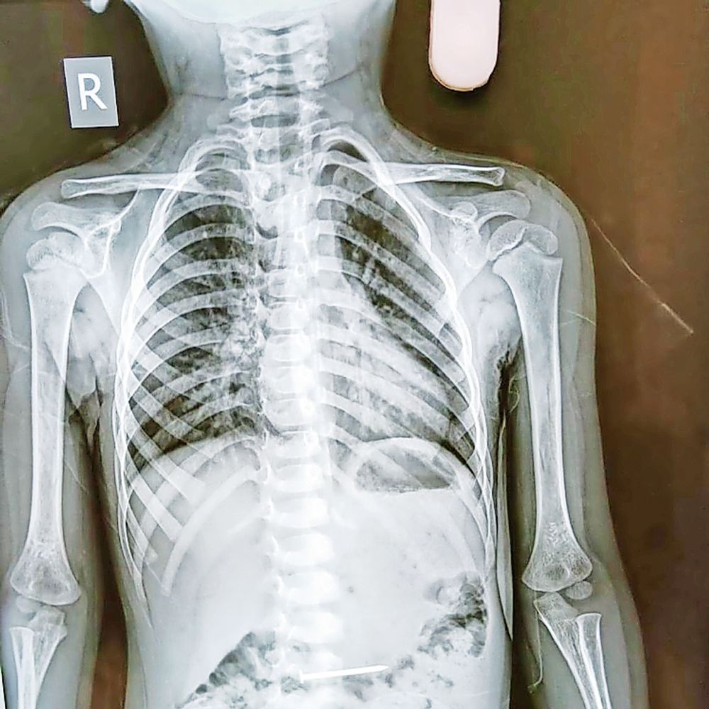 શ્રીમદ્ રાજચંદ્ર હોસ્પિટલ દ્વારા ચાર બાળકોને નવજીવન.