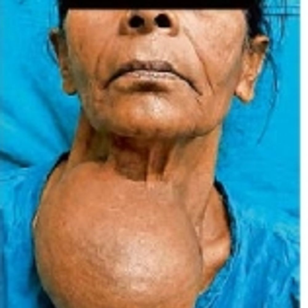 સર ટી. હોસ્પિટલમાં 700 ગ્રામની જટિલ થાઇરોઇડ ગાંઠની સફળ સર્જરી