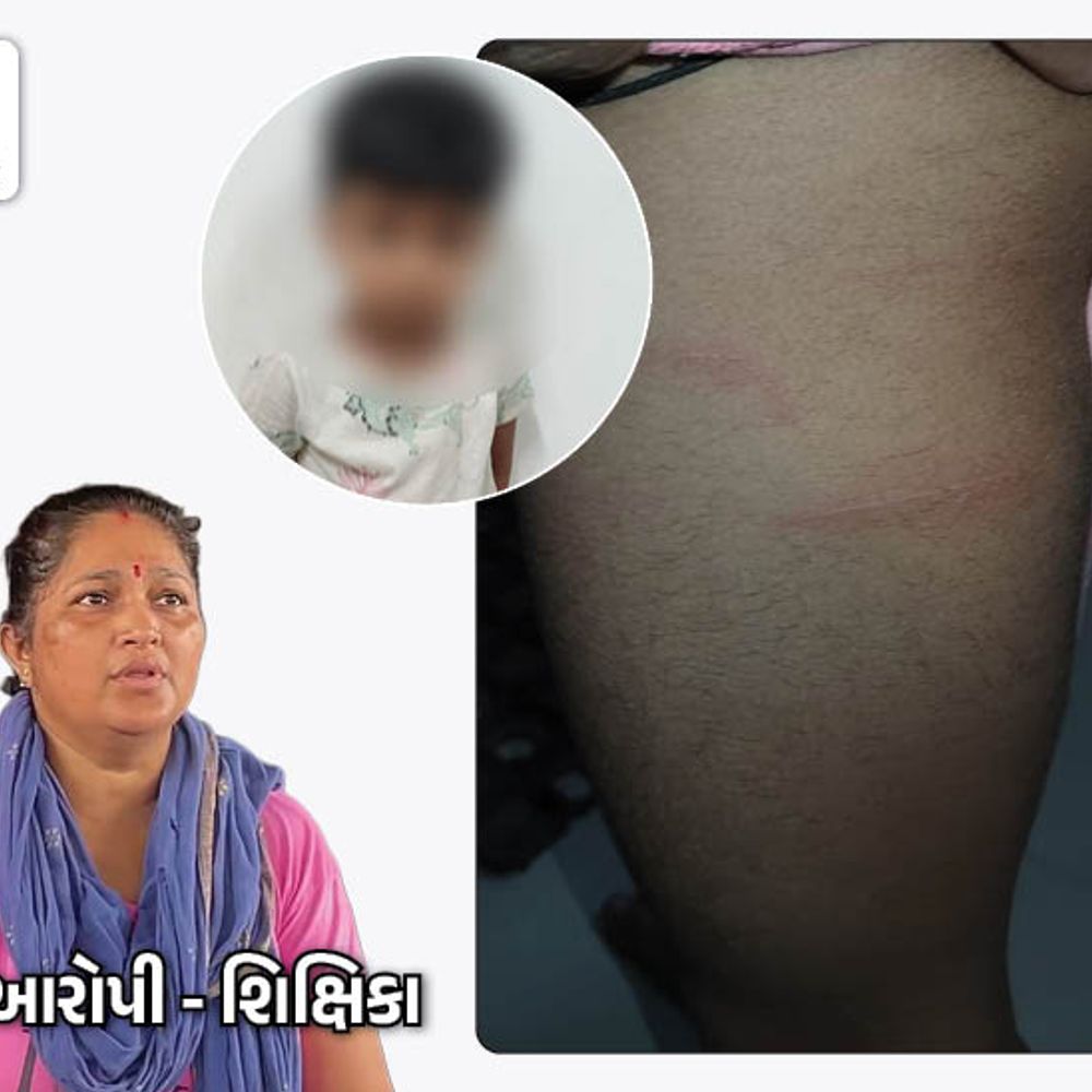 ટ્યૂશન ક્લાસિસના શિક્ષિકાએ 4 વર્ષીય બાળકને તાવીથાના ડામ આપ્યા:રાજકોટમાં મહિલા શિક્ષકનો ગોળ ગોળ જવાબ, વાલીનો આક્રોશ, કોચિંગ ક્લાસ માટે કડક કાયદો બનાવવા માગ