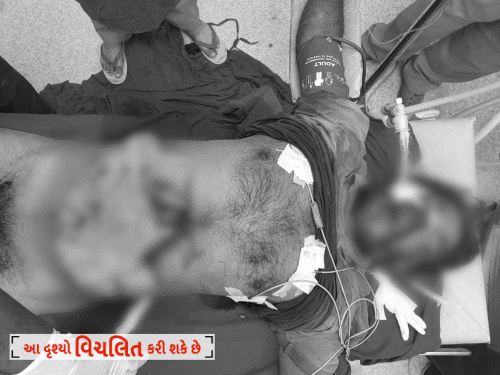પુત્ર પ્રાપ્તિની ઘેલછામાં 3 દીકરીના પિતાએ પોતાનું પેટ ચીરી નાખ્યું:પ્રસાદરૂપે માનતાના દાણાની સાથે 100ની નોટ ગળી જતા માનસિક સંતુલન ગુમાવ્યું, ગાંધીનગરનો શોકિંગ કિસ્સો