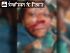 पति ने सो रही पत्नी का कुल्हाड़ी से एक हाथ और दूसरे की उंगलियां काट डालीं, डाॅक्टर बोले- एक हाथ की 3 उंगलियों के काम करने की उम्मीद नहीं|बैतूल,Betul - Dainik Bhaskar