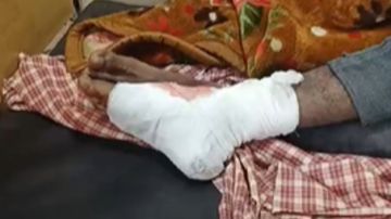 युवक के पैर में लगी गोली। गोली अंदर ही फंसी है, शाम 4 बजे होगा ऑपरेशन। - Dainik Bhaskar