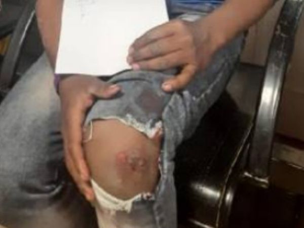 अस्पताल में घुटने पर लगी चोट की मरहम-पट्टी कराने की बारी के इंतजार में बैठा युवक।