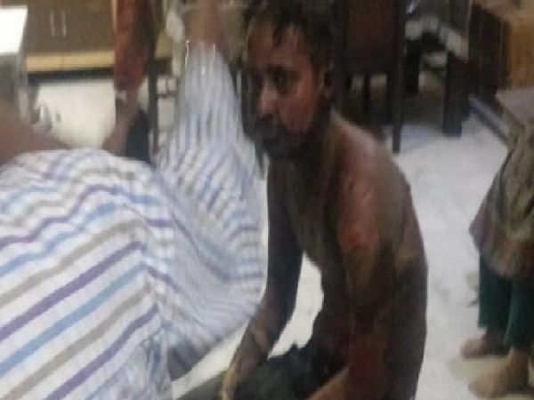 प्रेमिका के घर में आग लगाने के बाद झुलसा हुआ युवक। इसे पहले स्थानीय अस्पताल फिर चंडीगढ़ PGIMER में भर्ती कराया गया था।