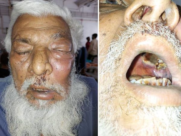 ब्लैक फंगस आंख की पुतलियों या आसपास का एरिया पैरालाइज्ड कर सकता है।