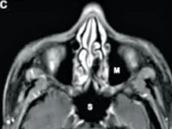 यह नॉर्मल स्कैन है। ब्लैक फंगस का संक्रमण नहीं है। सायनस में संक्रमण नहीं हाेने से वह काला दिख रहा है।