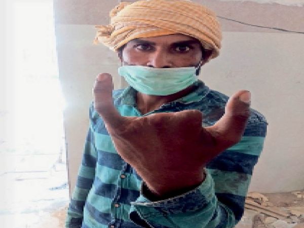 काटी गई अंगुलियों को दिखाते डेहा कॉलोनी निवासी अनिल।