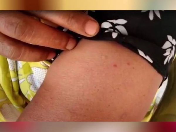 हाथ में टीका की 2 खुराक लेने वाली महिला के लक्षण।