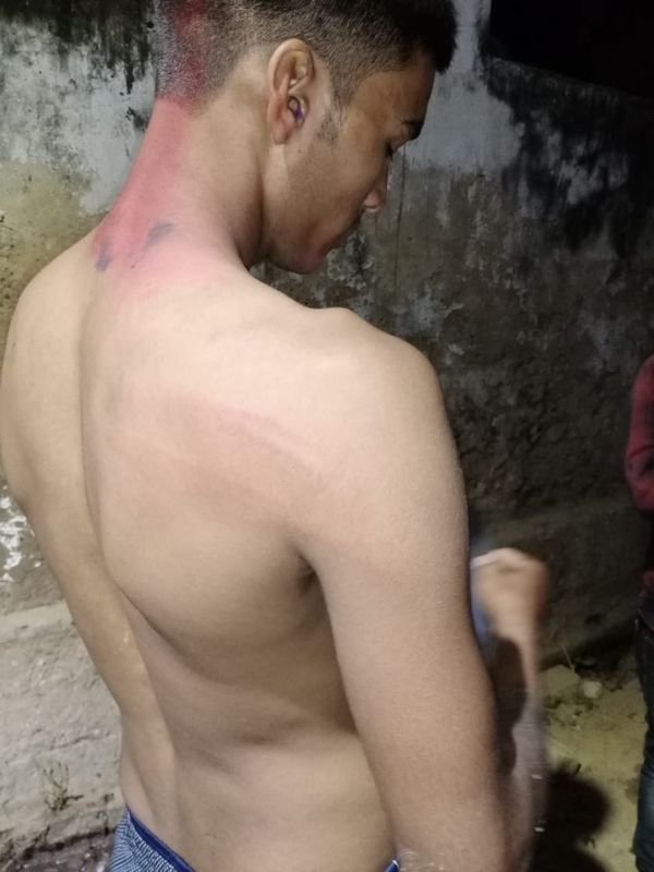 पुलिस की पिटाई के बाद अपने पीठ पर चोट के निशान दिखाता सौरव उर्फ बुचो।