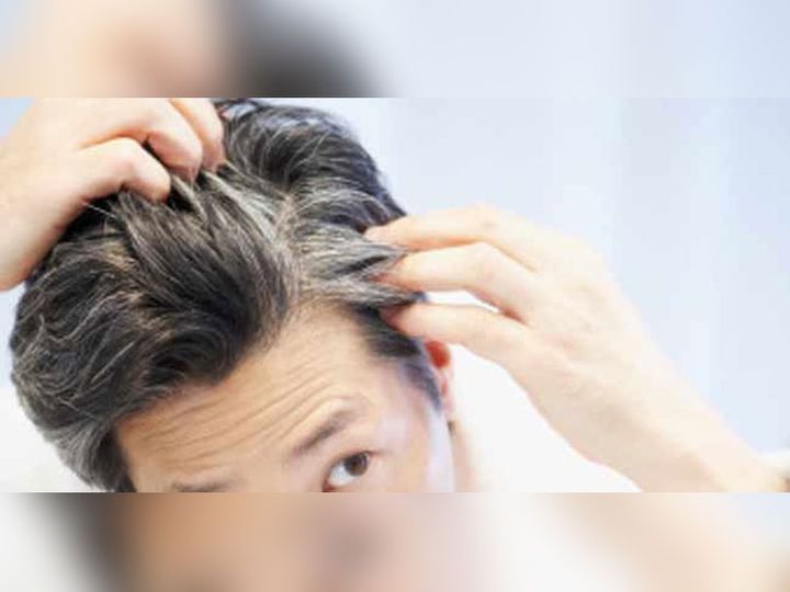 Causes Of White Hair In Young Age 