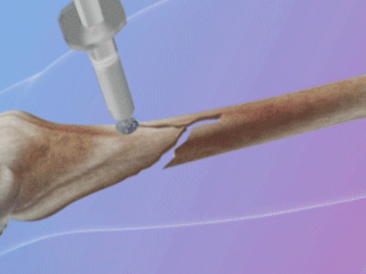China Bone Glue Fracture Treatment Explained | Plaster Metal Rod