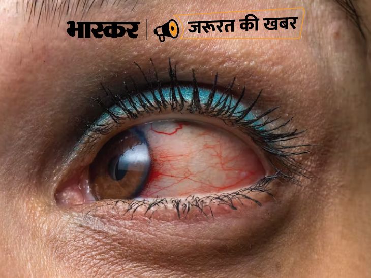 Contact Lenses Side Effects; Corneal Ulcer Symptoms, Causes Explained