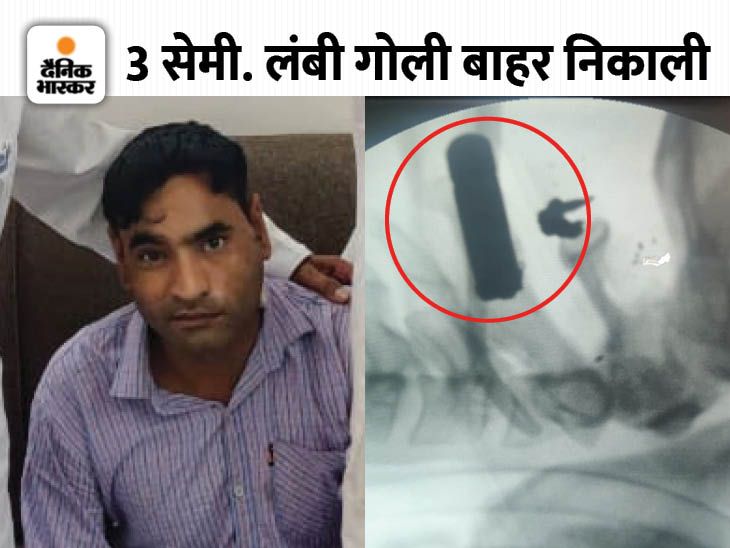 Jaipur Hospital; Doctor Removed Bullet From Neck जबड़ा काटकर निकाली