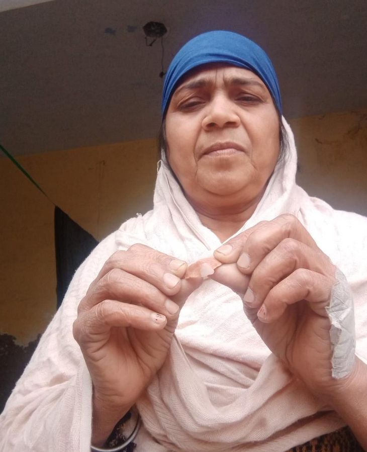 False tooth stuck in food pipe while eating, woman operated with the