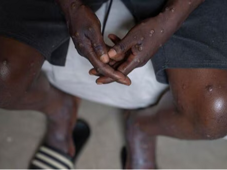 First case of monkeypox detected in Philippines | फिलीपींस में मिला मंकीपॉक्स का पहला केस: पहले पाकिस्तान और स्वीडन में भी वायरस मिला था, इस साल 500 से ज्यादा मौत