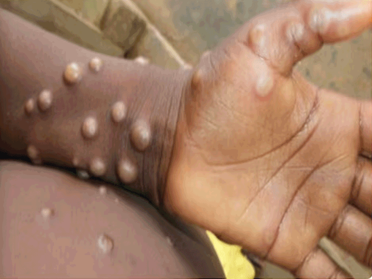 Monkeypox Outbreak; Serum Institute Mpox Vaccine | Adar Poonawalla | सीरम इंस्टिट्यूट मंकीपॉक्स वैक्सीन बनाएगा: CEO बोले- उम्मीद है एक साल में तैयार कर लेंगे, कोविशील्ड भी इसी कंपनी ने बनाई थी