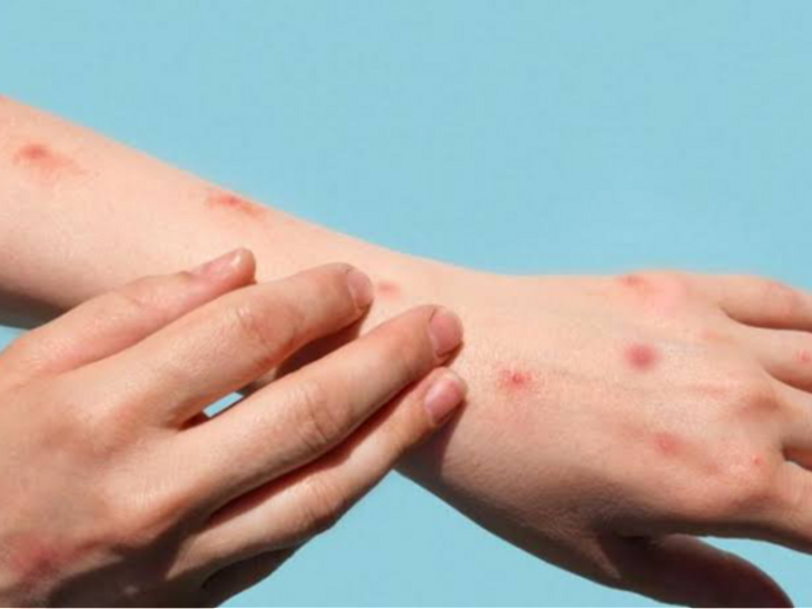 Monkeypox Virus Outbreak; Mpox Detection RT-PCR Assay KIT | WHO India | पाकिस्तान में मंकीपॉक्स का पांचवां केस मिला: मरीज की हालत स्थिर, सऊदी अरब से लौटा था; भारत में मंकीपॉक्स की जांच के लिए RT-PCR किट डेवलप