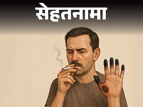 ब्युरर रोगाची लक्षणे (त्वचेचा रंग बदल) | सिगारेटचे धूम्रपान | सेहथानामा- सिगारेटचे धूम्रपान केल्याने बरगर रोग होऊ शकतो: हा आजार काय आहे, भारतातील लोक अधिक धोका का आहेत, डॉक्टर सांगत आहेत