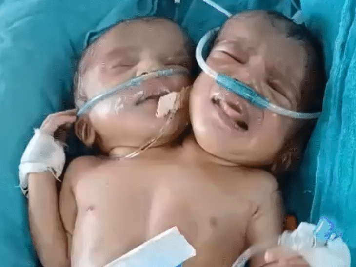 A child with two heads was born in Indore | इंदौर में जन्मी दो सिर एक धड़ वाली बच्ची: दो लिवर, एक दिल, दो फेफड़े; डॉक्टर बोले- दो लाख में ऐसा एक केस – Indore News