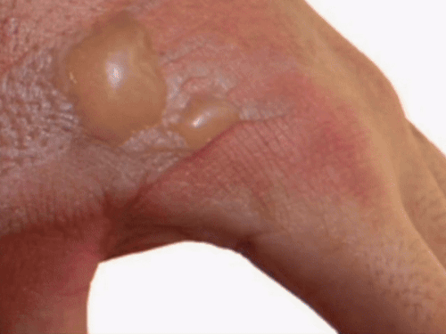 If you get burnt by a firecracker, do this first. | पटाखे से जलने पर ...