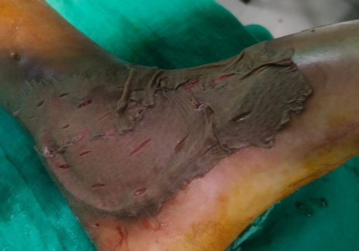 Skin grafting facility available at Jhalrapatan CHC, patient operated successfully | झालरापाटन सीएचसी में मिलने लगी स्किन ग्राफ्टिंग की सुविधा, रोगी का सफल ऑपरेशन – jhalawar News