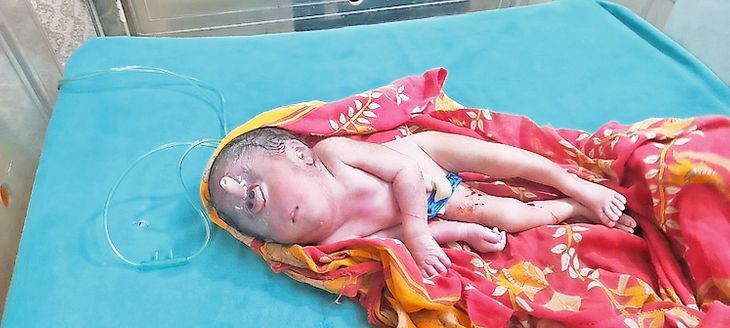 A newborn suffering from cyclopia was born at Simri CHC, leaving ...