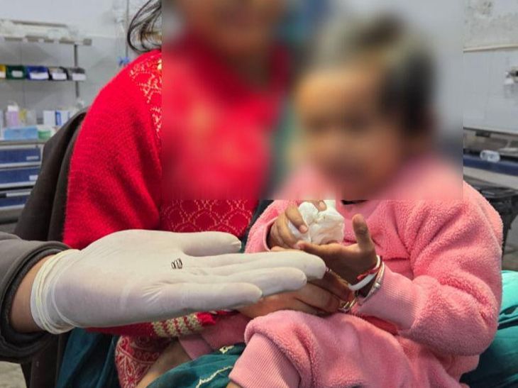 Pen spring stuck in girl's nose