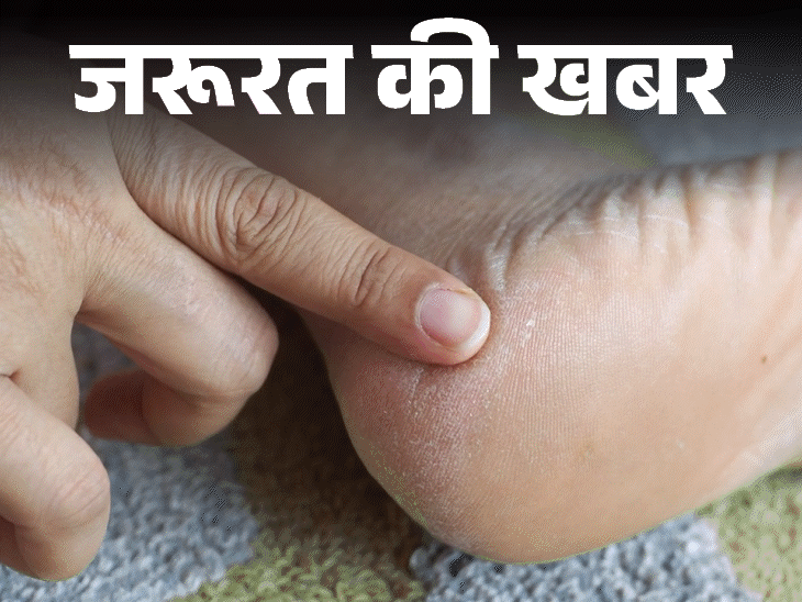 जरूरत की खबर- सर्दियों में फटती हैं एड़ियां:  डर्मेटोलॉजिस्ट से जानें कैसे करें ठीक, क्रैक्ड हील्स को मुलायम बनाने के 9 स्टेप्स